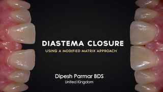 Diastema Closure Renamel with Dipesh Parmar [upl. by Sharp606]