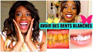 DENTS BLANCHES JE VOUS AI MENTI  Blanchiment facettes astuces [upl. by Leroj]