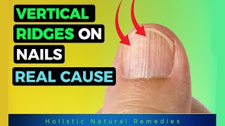 The REAL Causes of VERTICAL RIDGES On Your Nails [upl. by Lief]