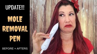 How to Get Rid of Skin Tags Moles Warts  PLASMA IQ vs PLASMA MOLE SKIN TAG REMOVAL PEN REVIEW DEMO [upl. by Lebbie146]