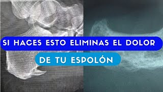 Como aliviar el dolor de espolón [upl. by Ecilegna]