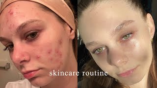 the skincare routine that FINALLY cleared my acne [upl. by Virgilia]