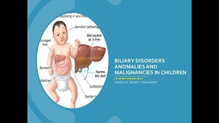 Biliary Disorders Anomalies and malignancies in children [upl. by Sanfourd916]