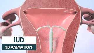 How does an IUD work  3D animation [upl. by Iverson]