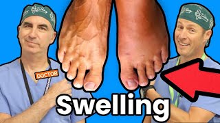 Foot and Ankle Swelling What Causes It [upl. by Ainolopa]