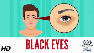 Black Eye Causes Signs and Symptoms Diagnosis and Treatment [upl. by Johan]