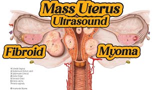 Uterus  Fibroid  Myoma  Mass On Ultrasound [upl. by Vesta]