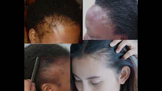 DANGERS OF HAIR BONDING GLUE [upl. by Esinet]