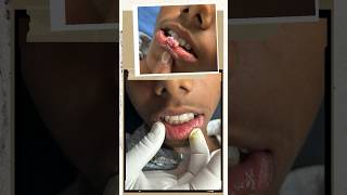 MucoceleGrannuloma pyogenic scarless surgeryHow To Remove An Oral Mucocele Lip ulcerLip lesion [upl. by Brandtr]