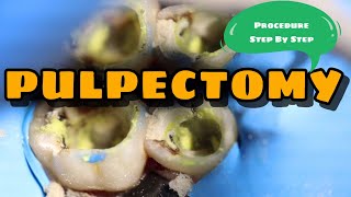 Pulpectomy  Procedure Step By Step  Kedo Square File [upl. by Aprilette]