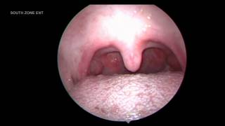 ATROPHIC TONSILS WITH GRANULAR PHARYNGITIS [upl. by Yseult]