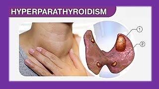 HYPERPARATHYROIDISM PART1  FULL EXPLANATION IN HINDI BY NG MEDICALS [upl. by Ennaeel]