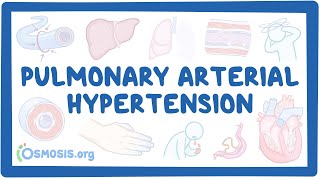 NORD  Pulmonary Arterial Hypertension [upl. by Eivi]