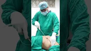 Cost of Gynecomastia Surgery in Delhi Manboobs Surgery shorts ytshort [upl. by Nairam]