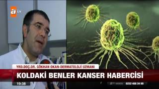 Koldaki benler kanser habercisi  23102015  atv Ana Haber [upl. by Anyahc]