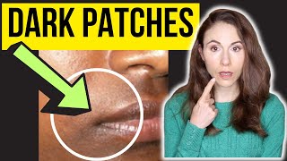 Dermatologist Explains Dark Patches Around The Mouth [upl. by Oiril657]