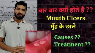 Mouth ulcers  Causes amp Treatment  मुँह मे छाले होने के कारण [upl. by Ritch]