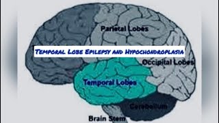 Temporal lobe epilepsy and hypochondroplasia [upl. by Neerahs80]