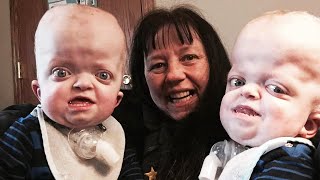 Grandma Adopts Twins With Rare Genetic Disease Says Shes Privileged [upl. by Staten]