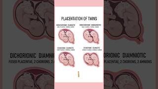 4 Types of twins medically Twin pregnancies pregnant youtubeshorts twins September 4 2024 [upl. by Haelem530]