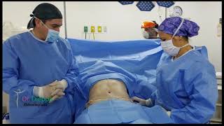 Cirugía Abdominal Abdominoplastia con Lipoescultura [upl. by Anen]