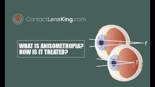 What is Anisometropia How is Anisometropia Treated [upl. by Hgiellek652]