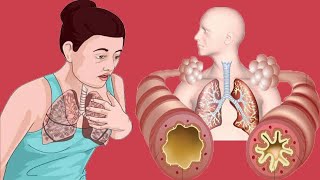 Cough Variant Asthma Causes And Symptoms [upl. by Alleuqcaj650]