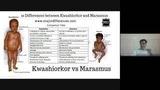 Kwashiorkor and Marasmus What’s the Difference [upl. by Martinez]