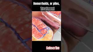 Hemorrhoids or piles surgery and treatment 3danimation viral short [upl. by Augustina]