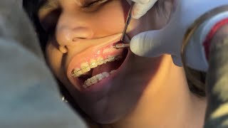 Orthodontic implant placement [upl. by Yllime]