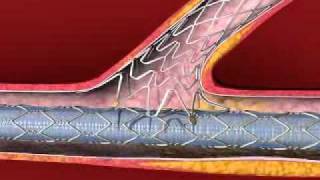 Sideguard coronary sidebranch stent by Cappella vidoe by Virtual Point [upl. by Kylynn]