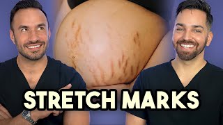 Major Announcement  How to Treat Stretch Marks like a Dermatologist [upl. by Paulsen]