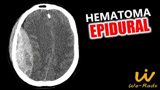 Hematoma Epidural [upl. by Vigen507]