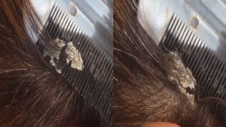 Dandruff Removal  Dandruff Extreme  Dandruff Scratching ASMR  Dandruff Treatment at Home 24 [upl. by Tortosa]