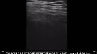 CASE 456 ultrasound avascular necrosis femoral head [upl. by Erlinna928]