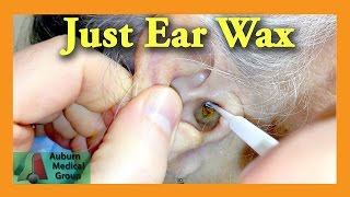 Ear Wax Removal Doctor  Auburn Medical Group [upl. by Aseretairam]