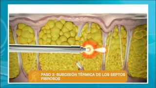 Eliminar la celulitis con el láser Cellulaze [upl. by Esinel]