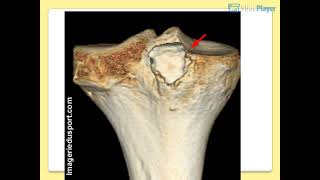 OSTEOLOGIE DU MEMBRE INFERIEUR [upl. by Moshell]