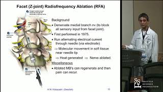 Radiofrequency Ablation RFA for Lumbar Facet Arthropathy Hisashi Wesley Kobayashi MD [upl. by Gwen766]