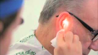 Ear Irrigation with a Propulse NG Ear Irrigatorwmv [upl. by Aihsekel172]