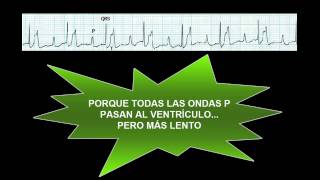 CURSO DE ELECTROCARDIOGRAFIA 39  BLOQUEO AV DE PRIMER GRADO [upl. by Bergwall]