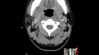 Epiglottic abscess as a complication of a fish bone [upl. by Juxon]