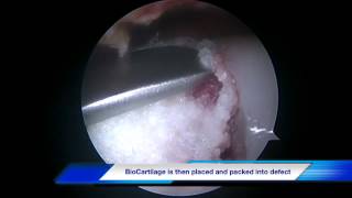 BioCartilage of the knee [upl. by Bechler547]