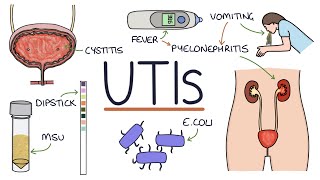 Understanding Urinary Tract Infections [upl. by Ahsemo]