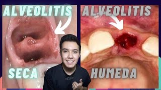 ALVEOLITIS HUMEDA Y SECA👅 CAUSAS TRATAMIENTO INFECCION DESPUES de una EXTRACCION DENTAL 🦷 [upl. by Salas]