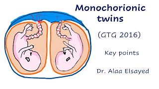 Monochorionic twins  GTG 2016 Key points [upl. by Asiral]