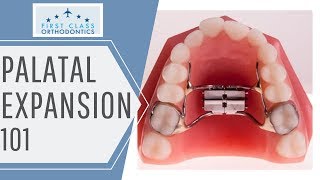 FIRST CLASS ORTHODONTICS  Palatal Expander 101 [upl. by Anerys]