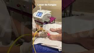 Arfurla laser nail fungus treatment equipment with 980nm 600um optical fiber toenail fungusremoval [upl. by Atiragram470]