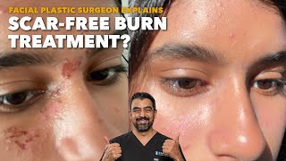 How to Treat Burns on Your Face Plastic Surgeon Tips [upl. by Eiboh]