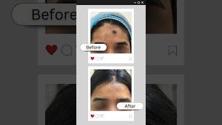 Face Lesion  Face Mark treatment drshalupunj result plasticsurgery [upl. by Onurb]